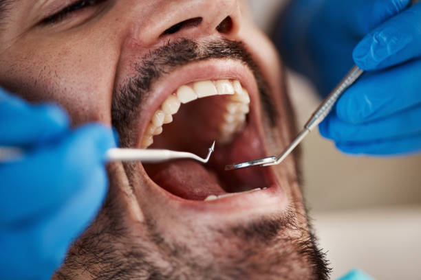 Best Emergency Dental Extractions in Natchitoches, LA